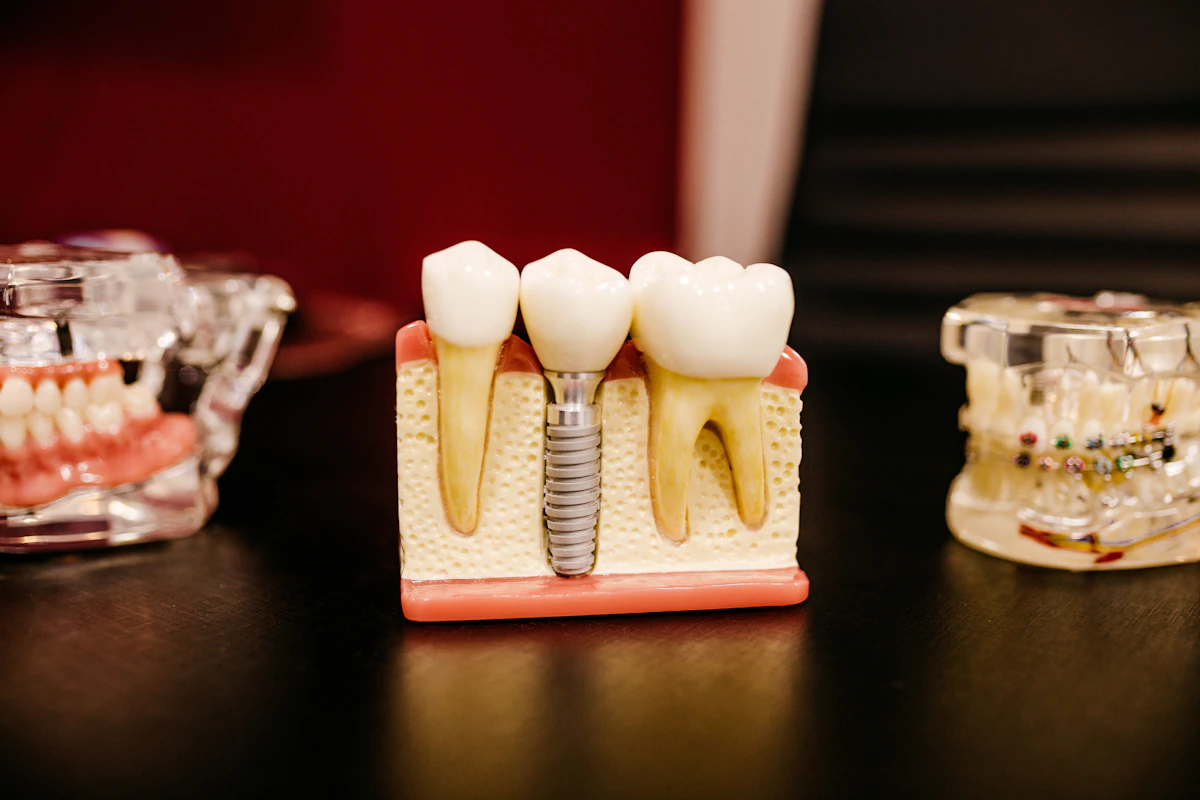 A dental implant model with a full arch of teeth on the consultation table
